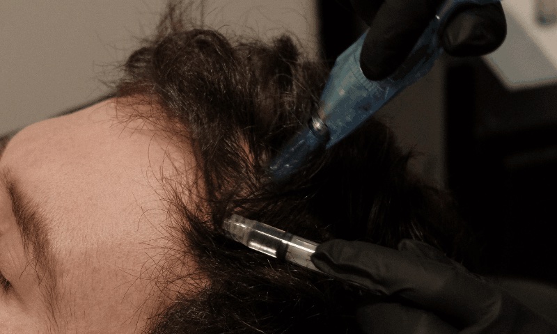 Microneedling for hair growth