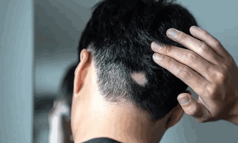 Alopecia areata explained