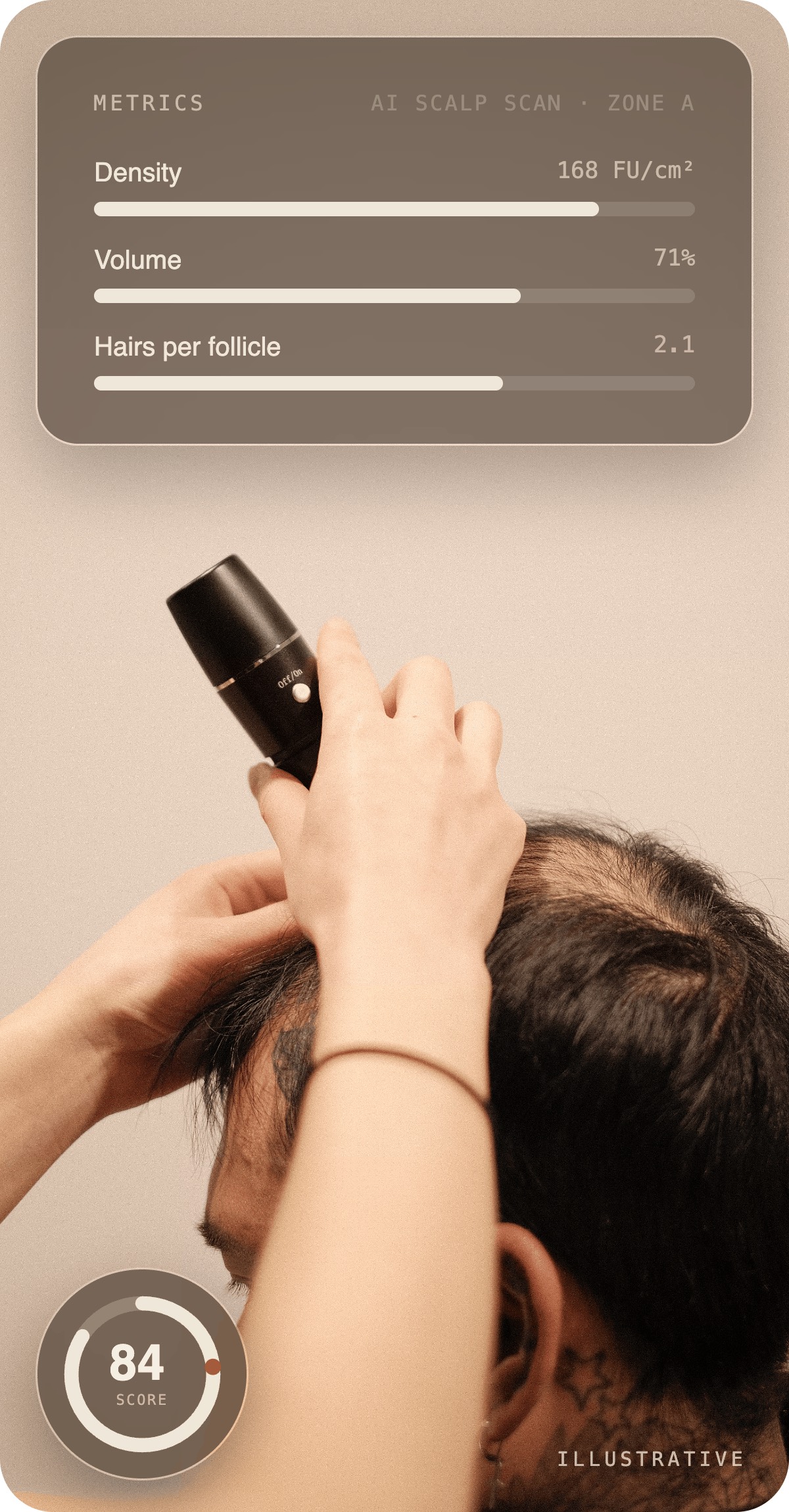 How progress is tracked at Scalp Series: follicle density metrics, a baseline to session six trend line, structured progress photography and an overall scalp score