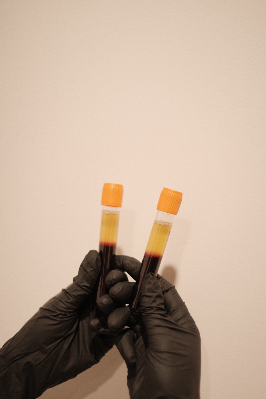 PRP treatment being performed at Scalp Series